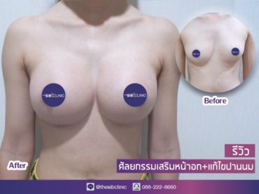 ทำหน้าอก เดอะซิบส์ คลินิก คุณนุ่น 1 รีวิวเสริมหน้าอก ทรง barbiebreast