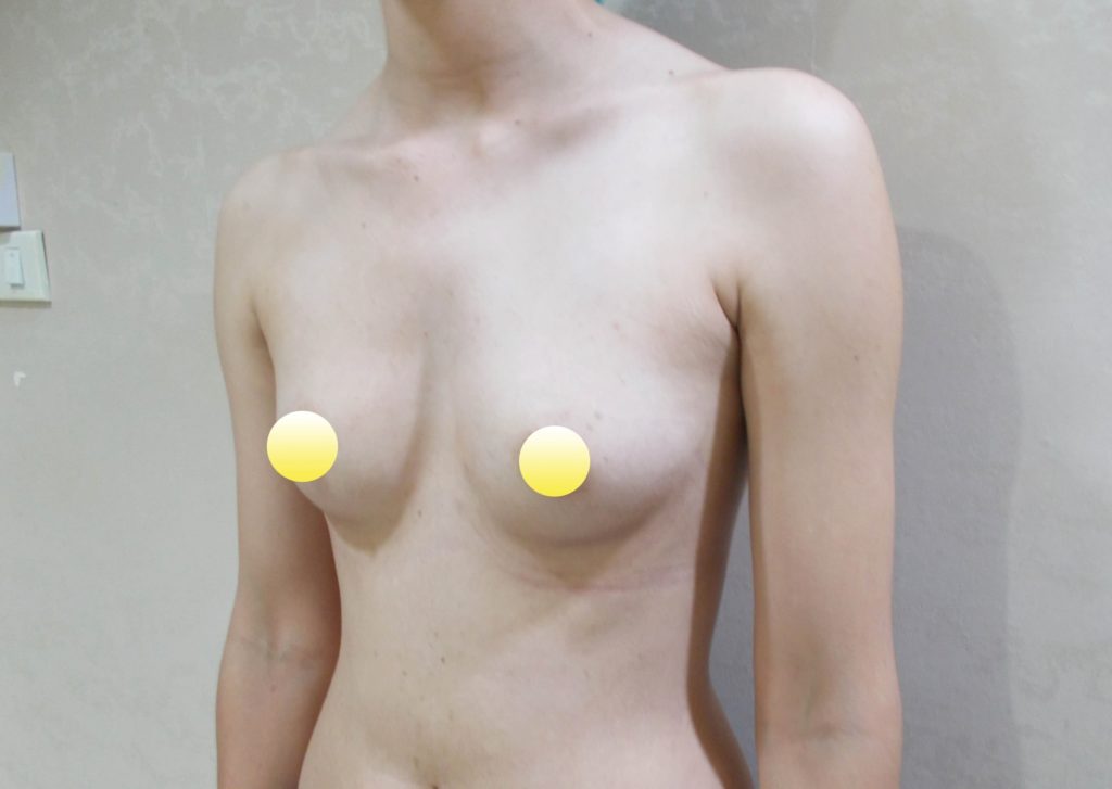 ทำหน้าอก เดอะซิบส์ คลินิก คุณนุ่น 2 รีวิวเสริมหน้าอก ทรง barbiebreast