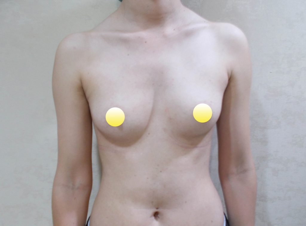 ทำหน้าอก เดอะซิบส์ คลินิก คุณนุ่น 3 รีวิวเสริมหน้าอก ทรง barbiebreast