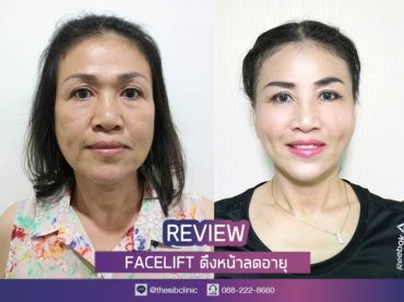 ดึงหน้า หน้าเด็ก ลดอายุ เดอะซิบส์ คลินิก FL2 1 รีวิว ทำ Facelift ที่ เดอะซิบส์ คลินิก ดูเด็กลง สาวจริง หน้าตึงเป๊ะ