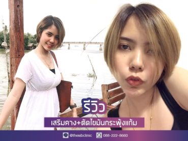 ทำคาง คางสาว ไขมันกระพุ้งแก้ม ตัดไขมันกระพุ้งแก้ม เดอะซิบส์ คลินิก คุณเมย์ 1 รีวิว หน้าเรียวเล็ก ด้วยการเสริมคาง + ตัดไขมันกระพุ้งแก้ม ที่ เดอะซิบส์ คลินิก