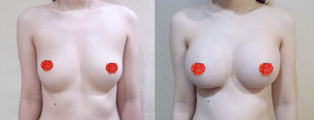 ทำหน้าอก ทำนม Barbie Breast เดอะซิบส์ คลินิก 10 รีวิวเสริมหน้าอก 20 วัน หน้าอกสวยมากค่า ขออวดหนิสส