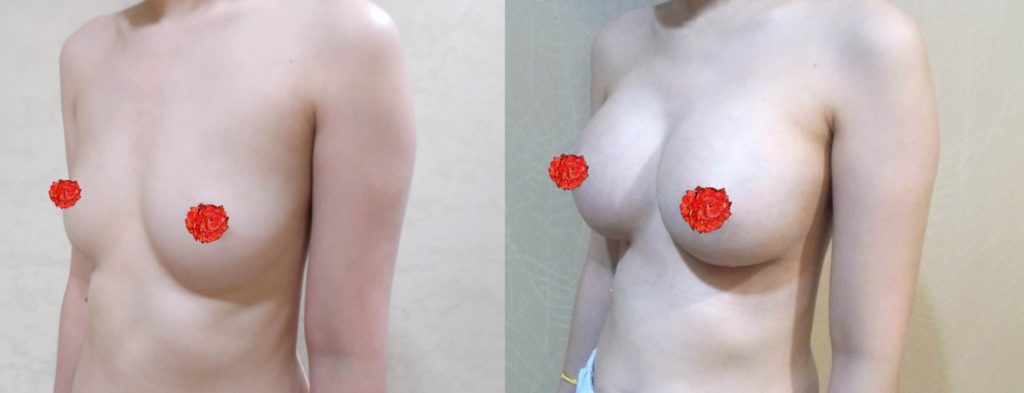 ทำหน้าอก ทำนม Barbie Breast เดอะซิบส์ คลินิก 11 รีวิวเสริมหน้าอก 20 วัน หน้าอกสวยมากค่า ขออวดหนิสส