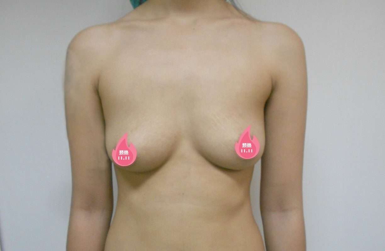 หน้าอกคล้อยข้างเดียว รีวิวแก้ไขยกกระชับตัวที ที่ เดอะซิบส์ คลินิก