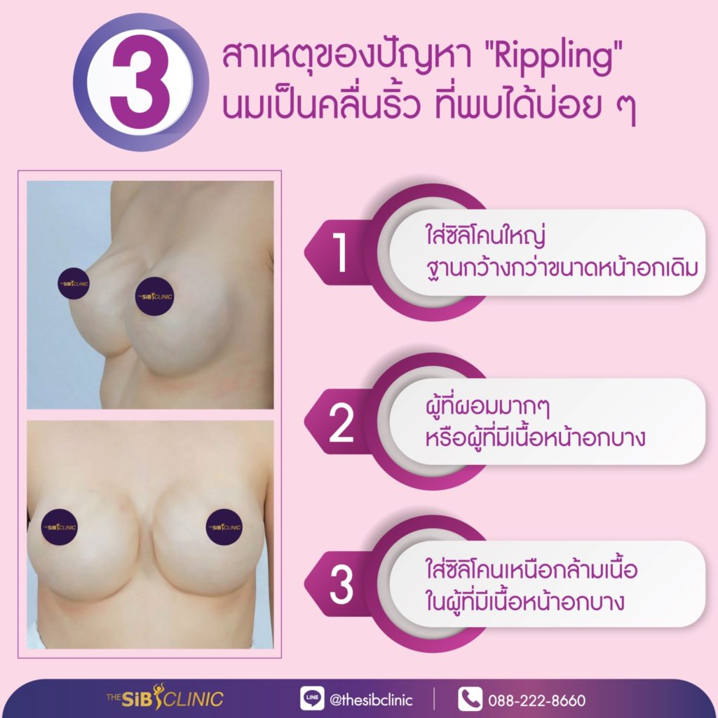 ทำหน้าอก เดอะซิบส์ คลินิก นมเป็นคลื่นริ้ว 6 นมเป็นคลื่นริ้ว (Rippling)