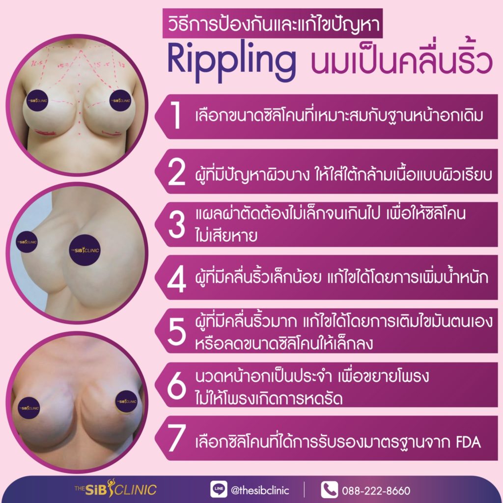 ทำหน้าอก เดอะซิบส์ คลินิก นมเป็นคลื่นริ้ว 7 นมเป็นคลื่นริ้ว (Rippling)