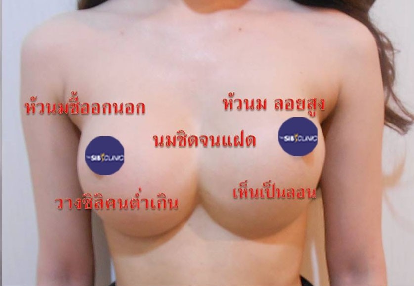 ทำหน้าอก เดอะซิบส์ คลินิก นมแฝด 5 ภาวะนมแฝด คืออะไร? (Symmastia)