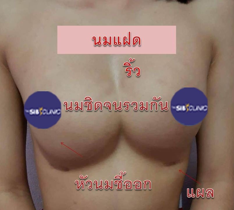 ทำหน้าอก เดอะซิบส์ คลินิก นมแฝด 6 ภาวะนมแฝด คืออะไร? (Symmastia)