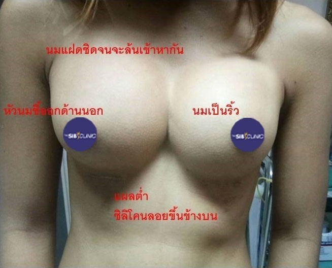 ทำหน้าอก เดอะซิบส์ คลินิก นมแฝด 7 ภาวะนมแฝด คืออะไร? (Symmastia)