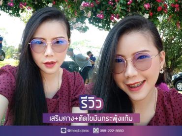 รีวิว เสริมคาง ตัดไขมันกระพุ้งแก้ม เดอะซิบส์ คลินิก คุณเมย์