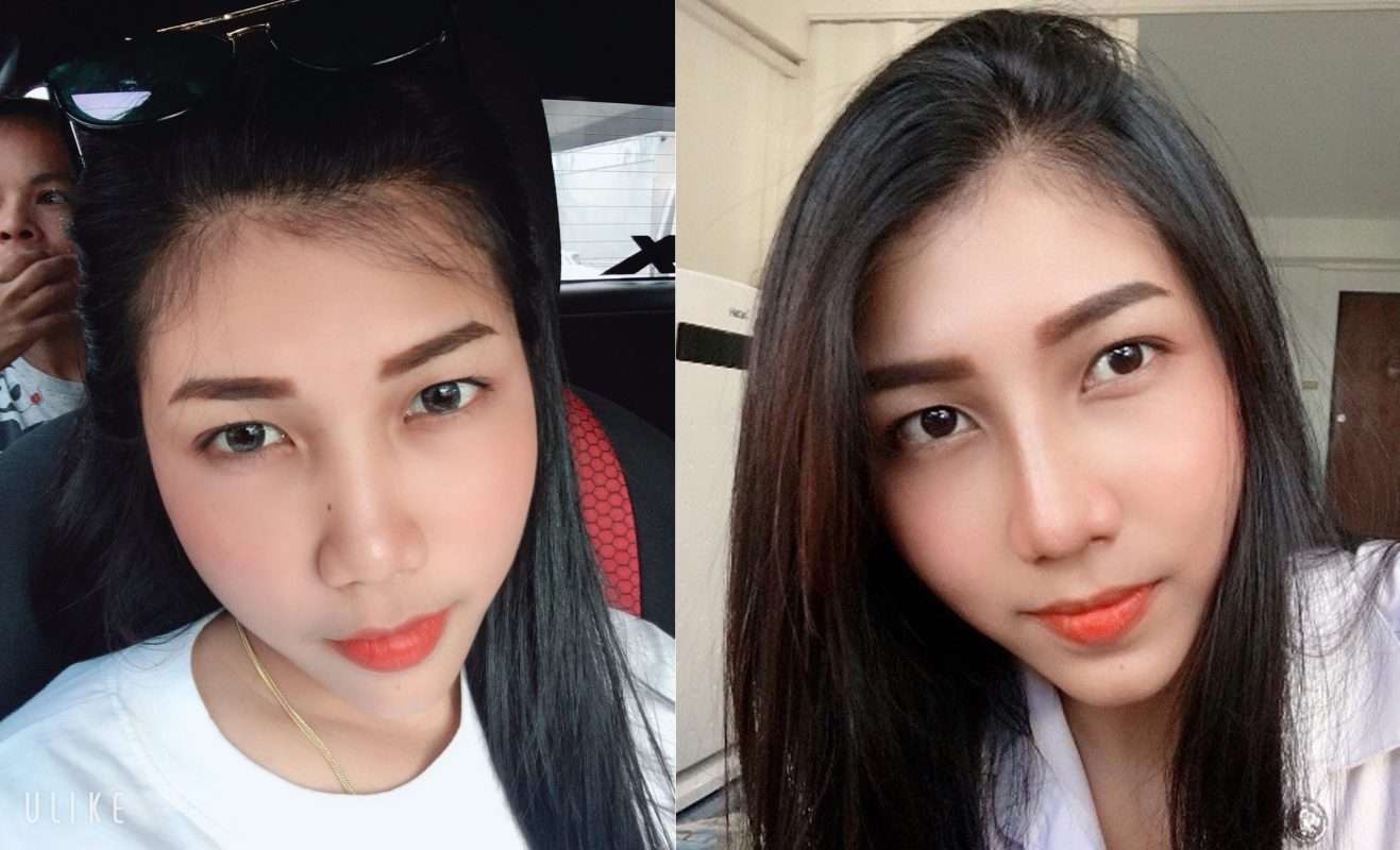 รีวิวประสบการณ์ เสริมจมูกที่ไหนดี ครั้งแรก จากคนที่กลัวเข็มที่สุดชีวิต!