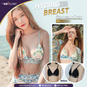 1 เสริมหน้าอกHybrid Breast