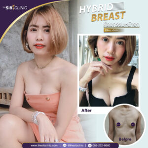 2 1 เสริมหน้าอกHybrid Breast