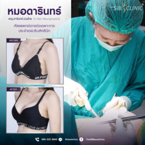 ADหมอ 01 1 เสริมหน้าอกHybrid Breast