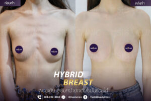 HybridBreast1 เสริมหน้าอกHybrid Breast