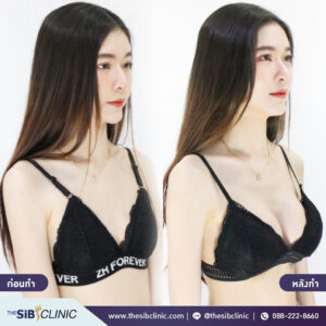 Hybrid Story2.3 เสริมหน้าอกHybrid Breast