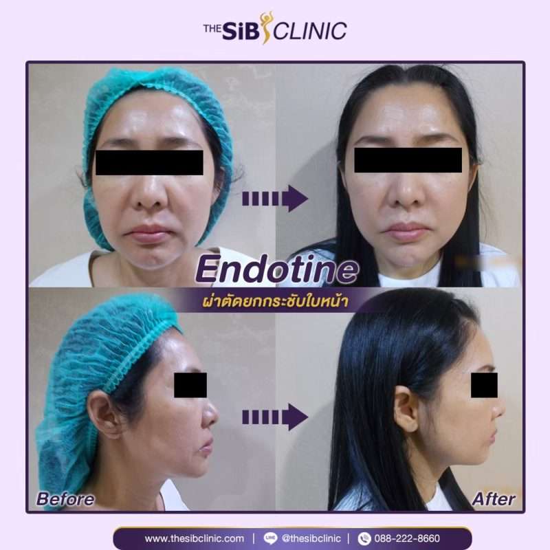 ร้อยไหม Endotine – ยกกระชับใบหน้าอย่างปลอดภัย เห็นผลไว ไม่ต้องผ่าตัด ร้อยไหม Endotine – ยกกระชับใบหน้าอย่างปลอดภัย เห็นผลไว ไม่ต้องผ่าตัด