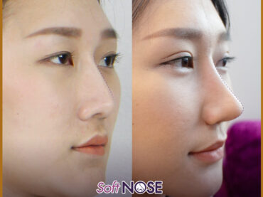 soft nose แก้จมูกปรับทรงสโลป 01 ศัลยกรรมเสริมจมูก Nose Surgery