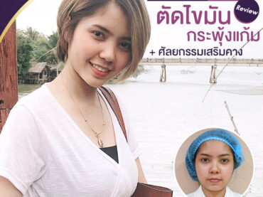 2 ตัดไขมันกระพุ้งแก้ม