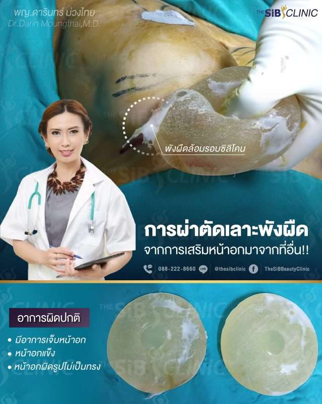 นมแข็งหลังเสริมหน้าอก