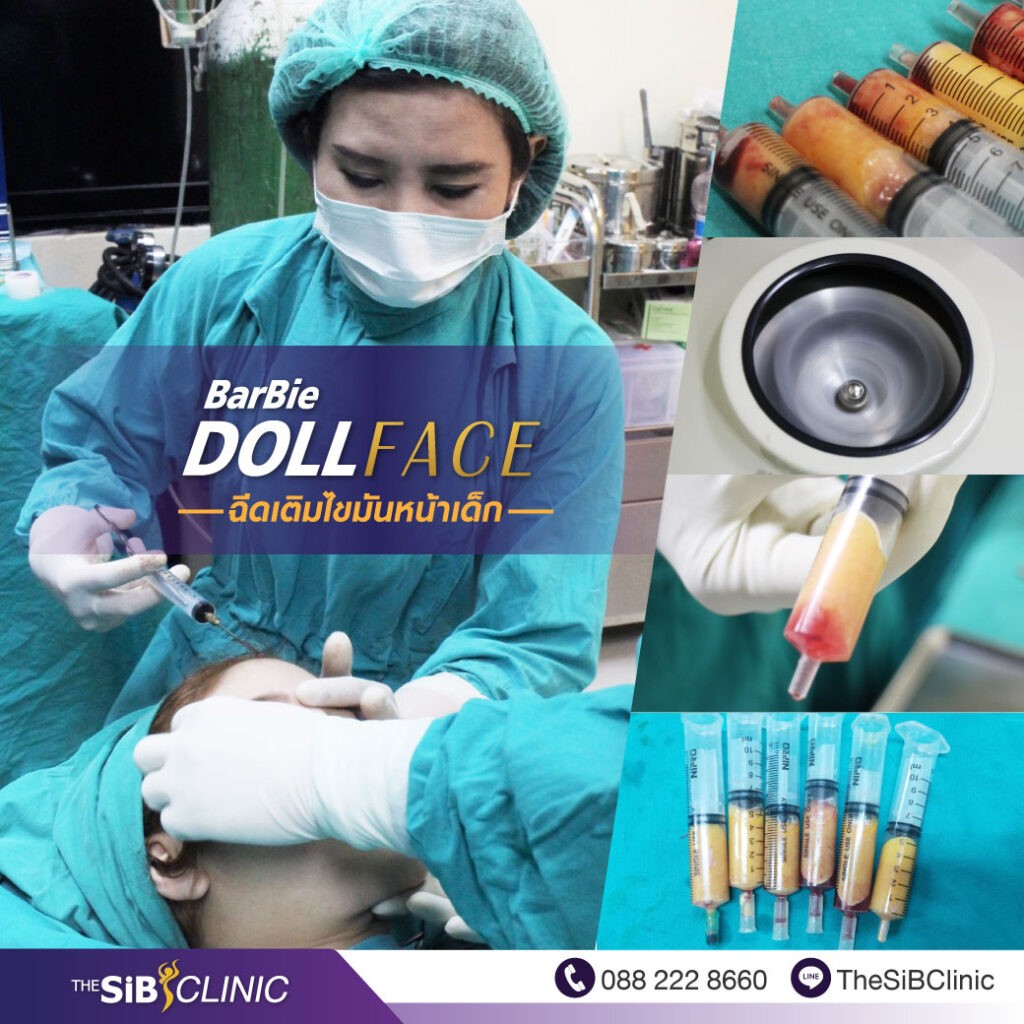 Barbie Doll Face Fat Grafting – The SIB Plastic Surgery