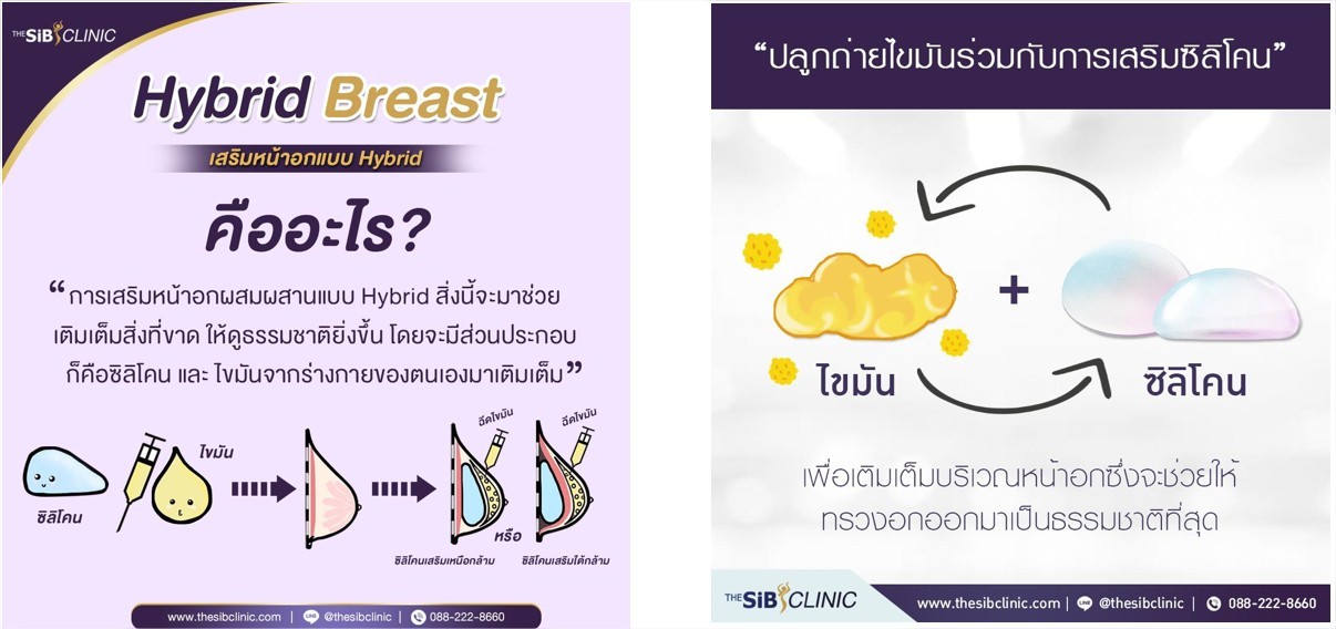 Hybrid Breast Word เสริมหน้าอก Hybrid breast