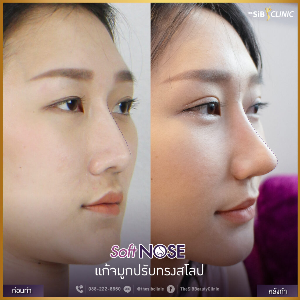 soft nose แก้จมูกปรับทรงสโลป 01 ศัลยกรรมจมูก