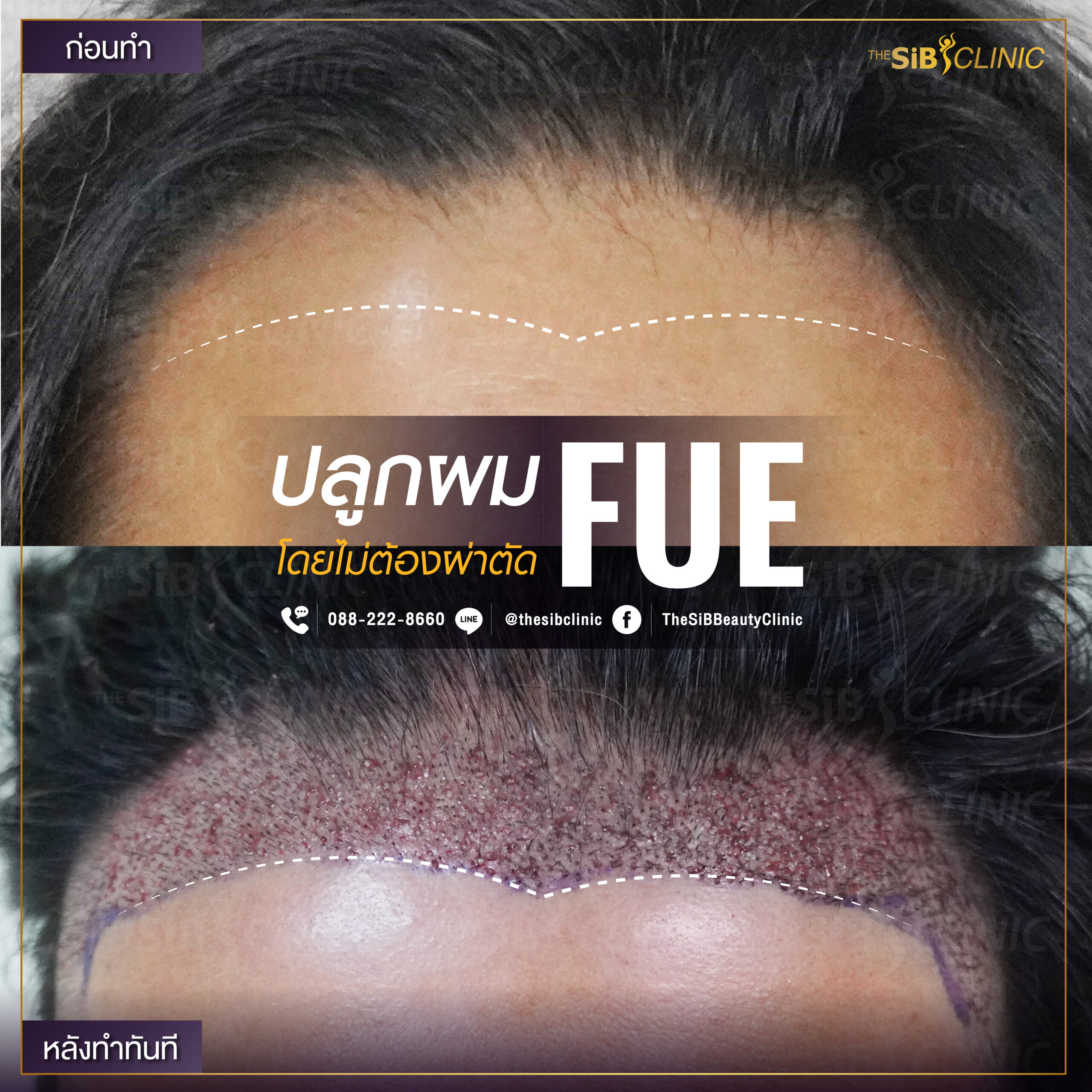 01 1 scaled ปลูกผมBefore-After