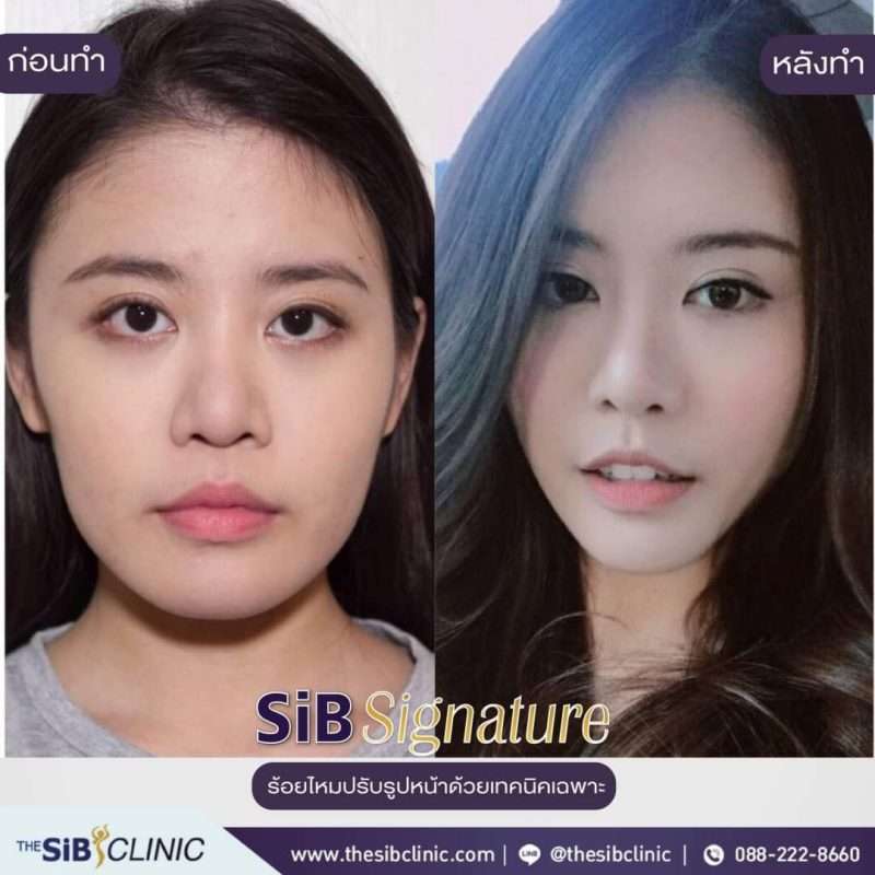 ดึงหน้า vs ร้อยไหม