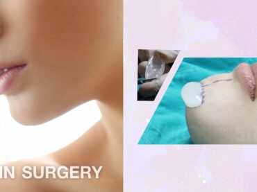 1 ศัลยกรรมเสริมคาง CHIN SURGERY