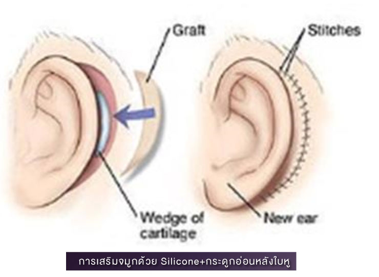 2 ศัลยกรรมจมูก