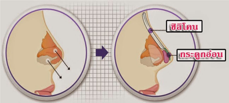 3 ศัลยกรรมจมูก