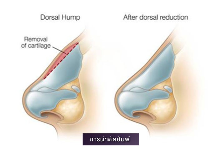 4 ศัลยกรรมจมูก