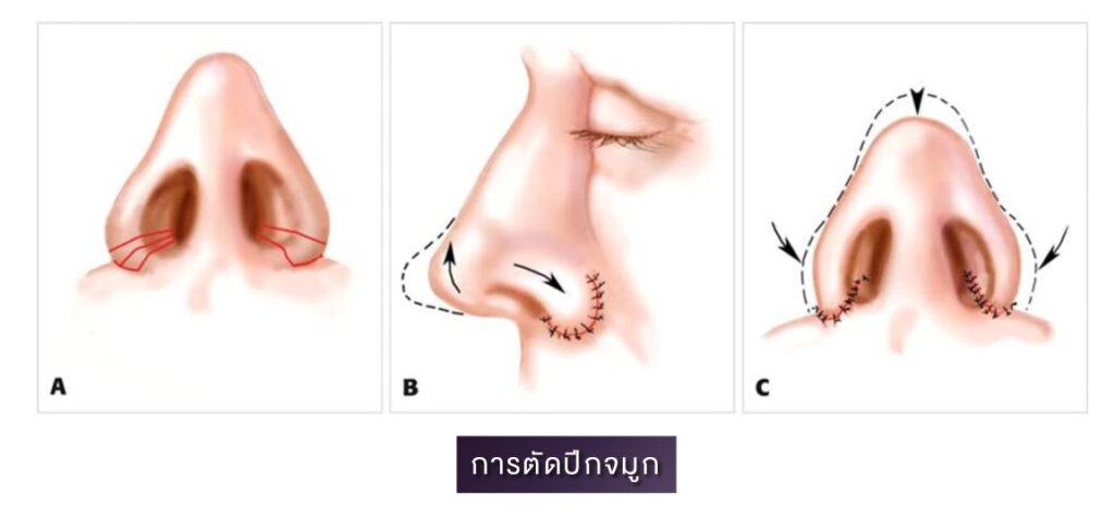 6 ศัลยกรรมจมูก