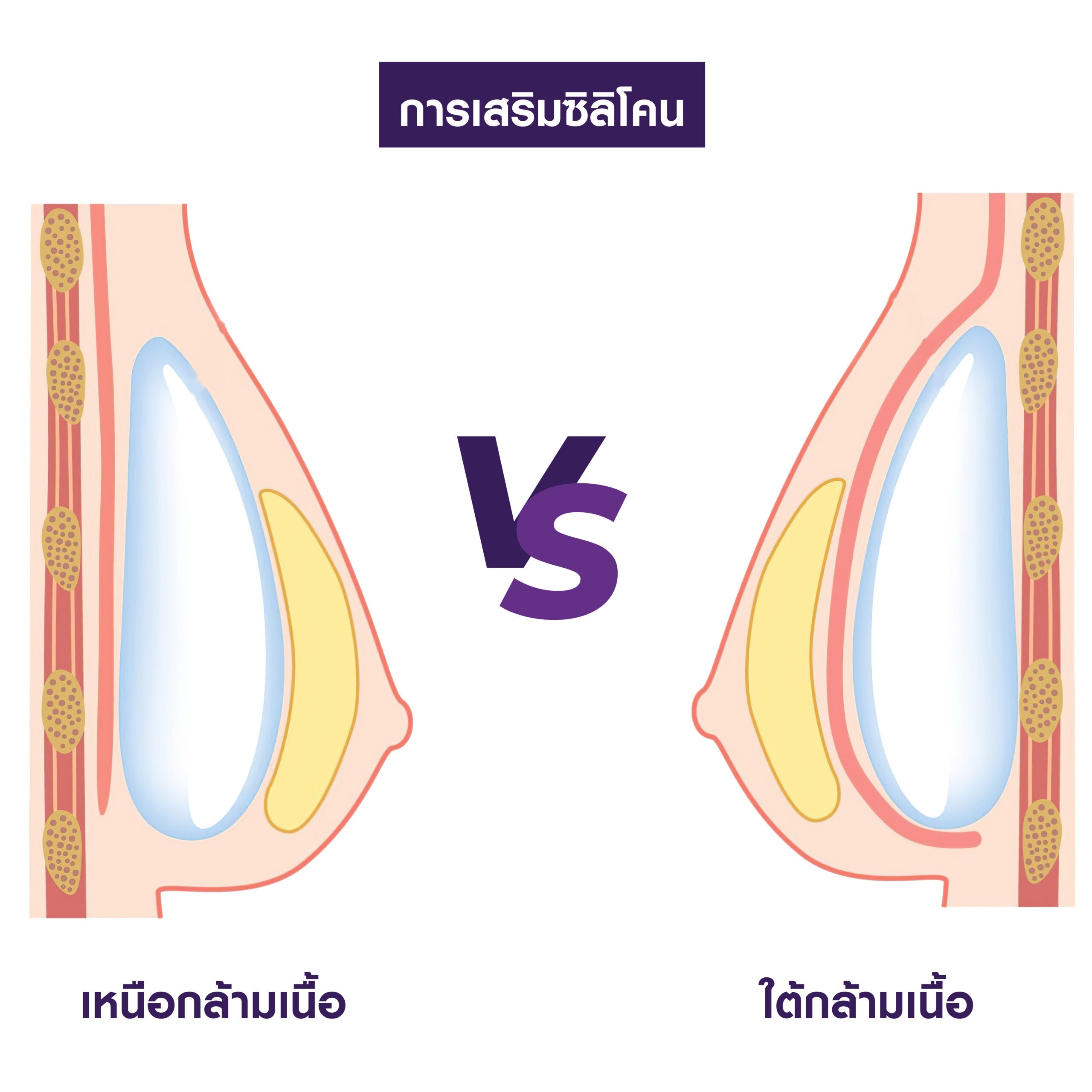 06 scaled เสริมหน้าอก ขั้นพื้นฐาน