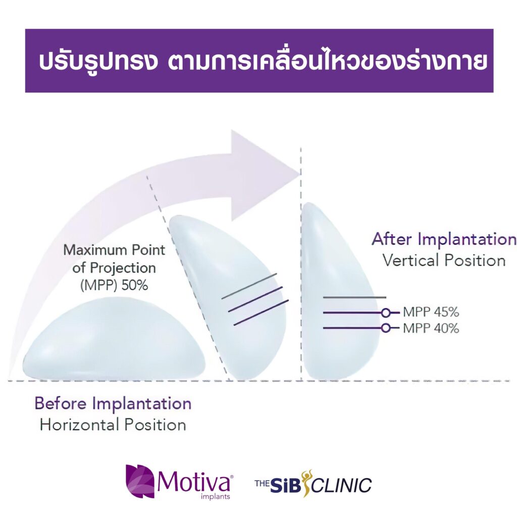 word image 20 ทำรู้จักซิลิโคน Motiva Ergonomix พร้อมจุดเด่นที่แตกต่างจากซิลิโคนทั่วไป