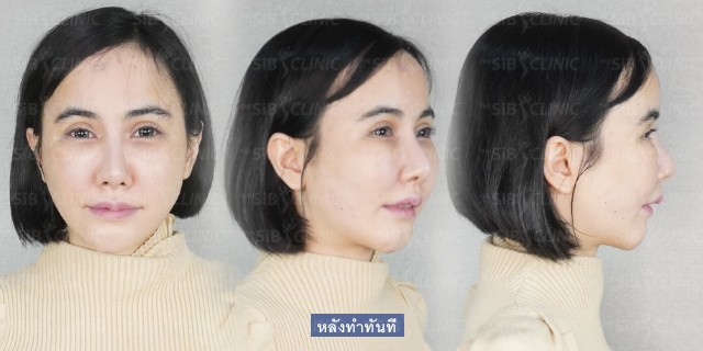 word image 36 รีวิวร้อยไหม หน้ายกกระชับ