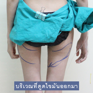 word image 57 รีวิวเสริมหน้าอก เติมไขมัน คุณพลอย ที่ The SIB Clinic