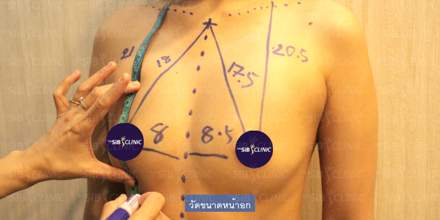 คุณโบโย่ มารีวิวเสริมหน้าอกขนาด 335CC