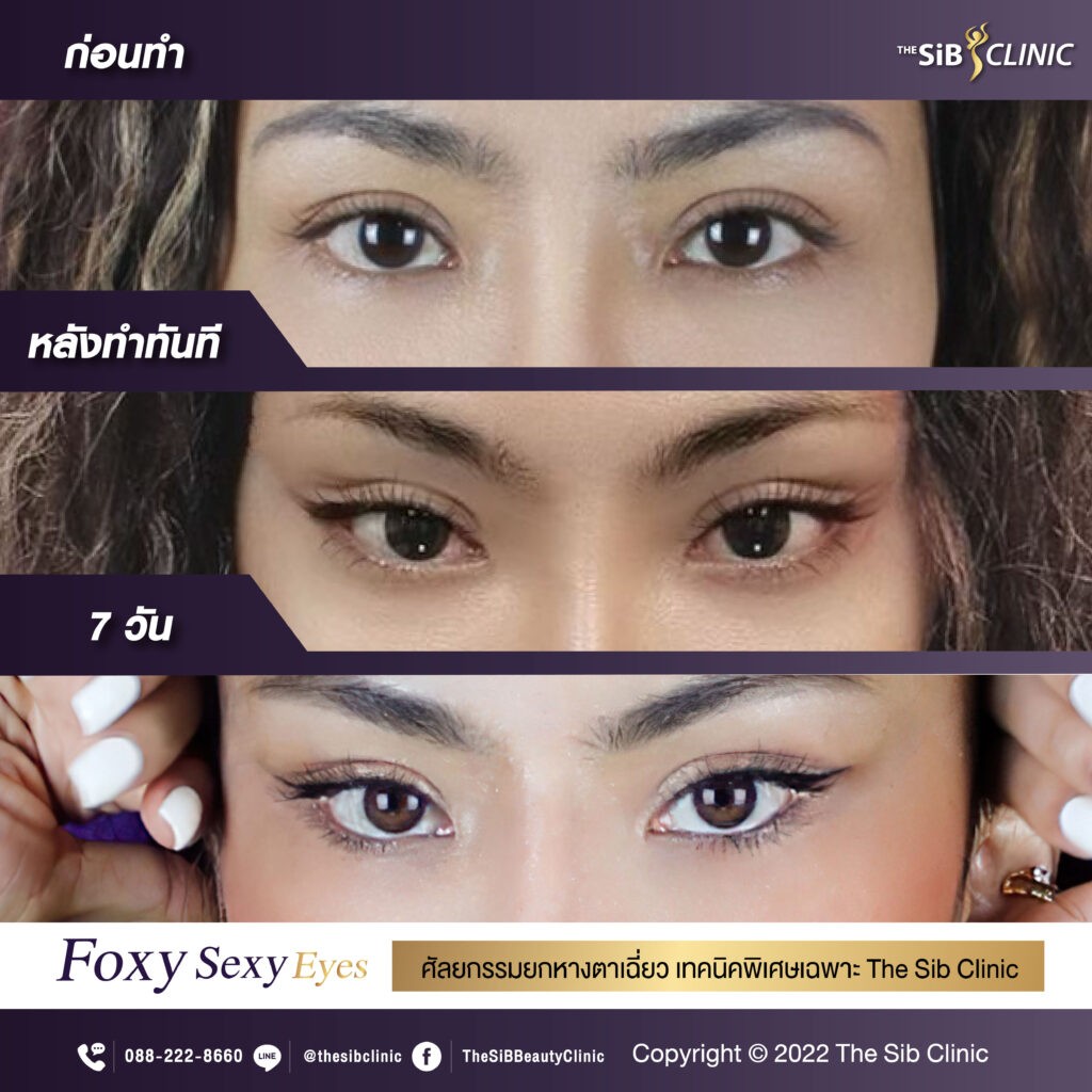 Foxy Sexy Eyes ยกหางตาเฉี่ยว แก้หางตาตก