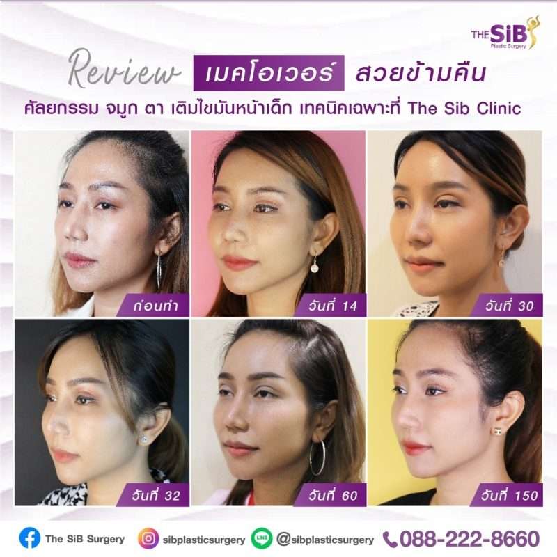 ศัลยกรรมหน้าเด็ก เสริมจมูก แก้ตาสองชั้น