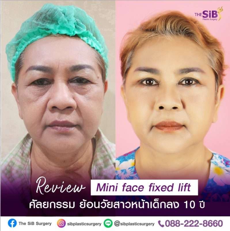 ย้อนเวลาสู่วัยสาว Mini Face Lift หน้าเด็ก ลดวัย 30 อีกครั้ง!