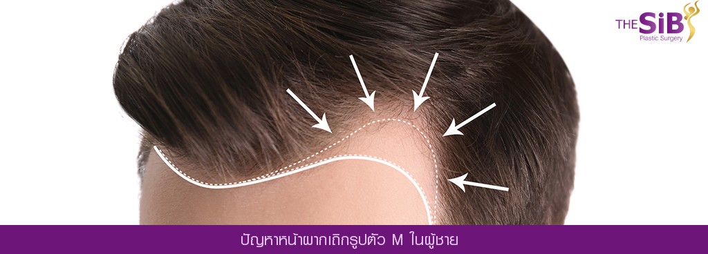 ศัลยกรรมปลูกผม Hair Transplant The SiB Plastic Surgery