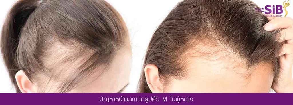 ศัลยกรรมปลูกผม Hair Transplant The SiB Plastic Surgery