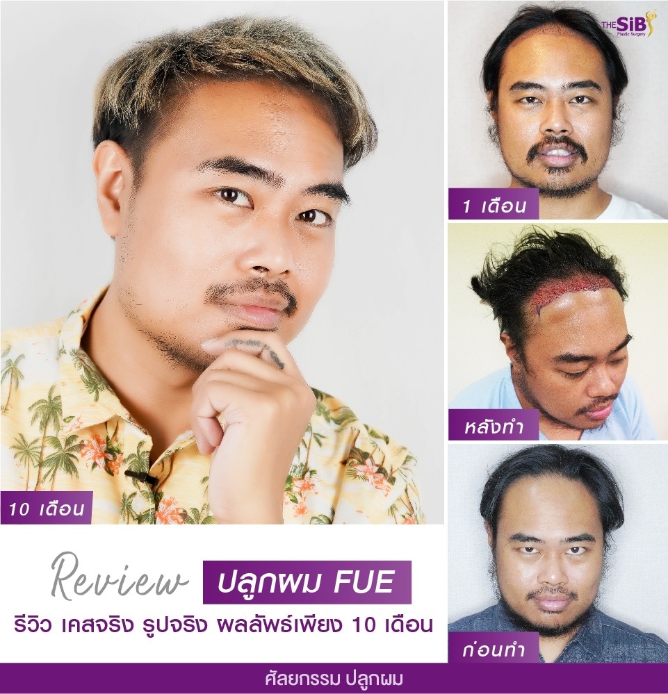 ศัลยกรรมปลูกผม Hair Transplant The SiB Plastic Surgery