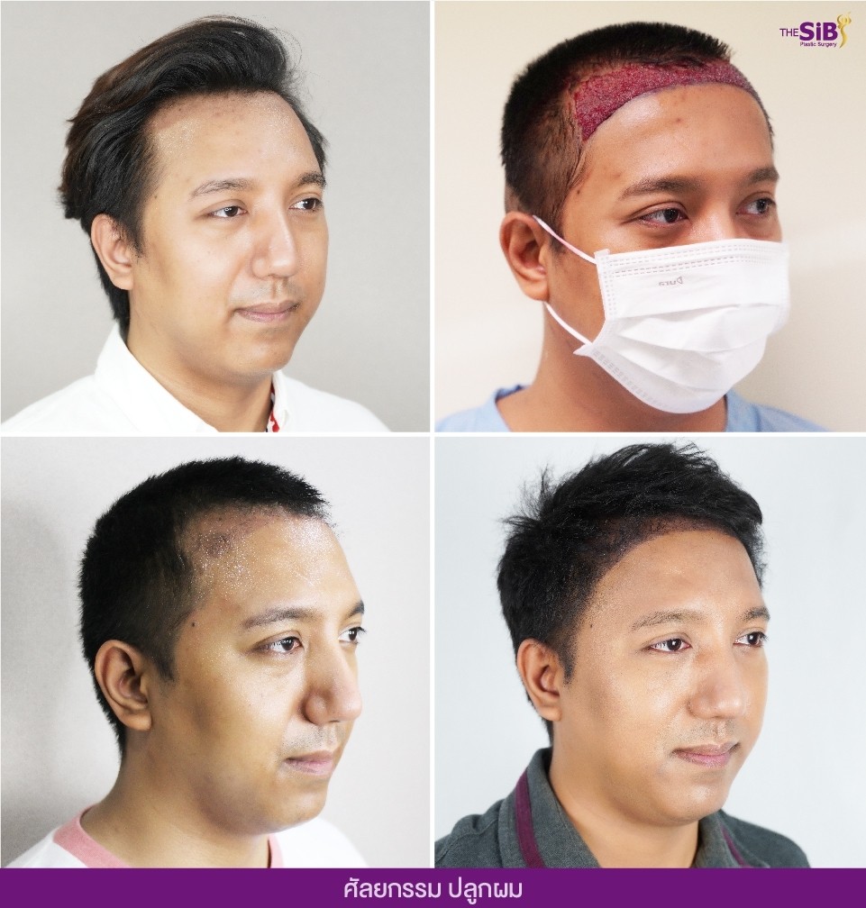 ศัลยกรรมปลูกผม Hair Transplant The SiB Plastic Surgery