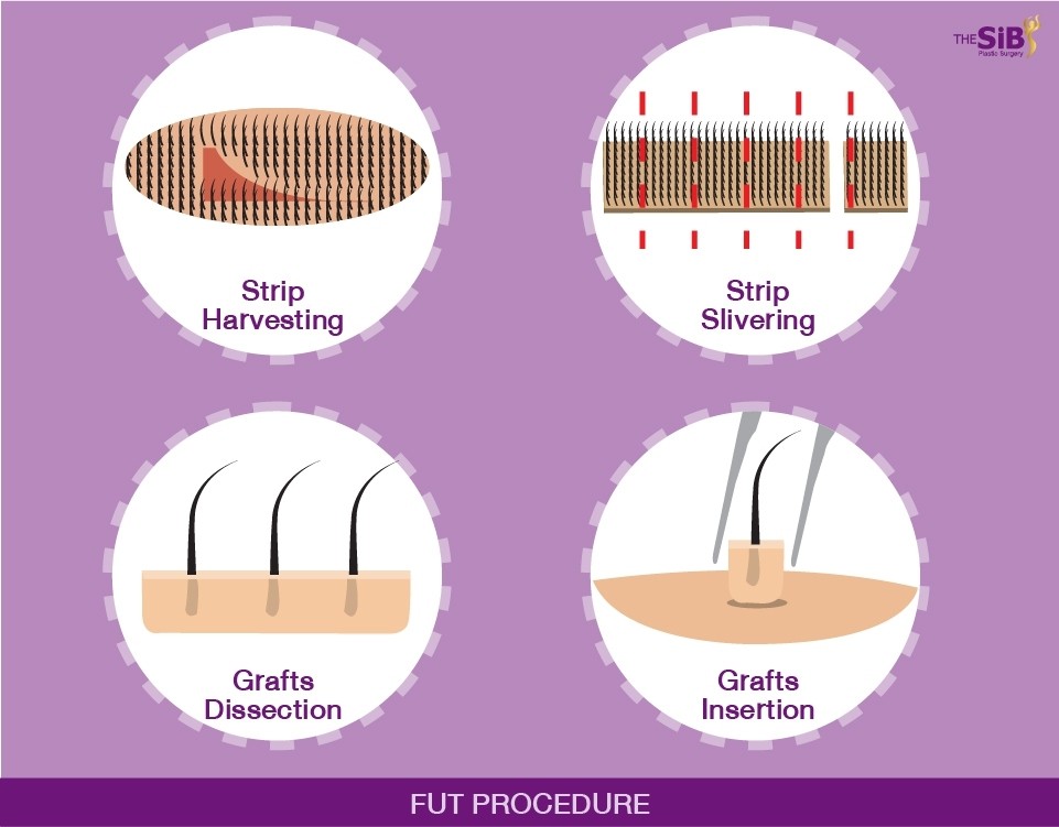 ศัลยกรรมปลูกผม Hair Transplant The SiB Plastic Surgery