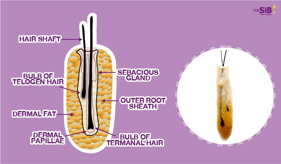 ศัลยกรรมปลูกผม Hair Transplant The SiB Plastic Surgery