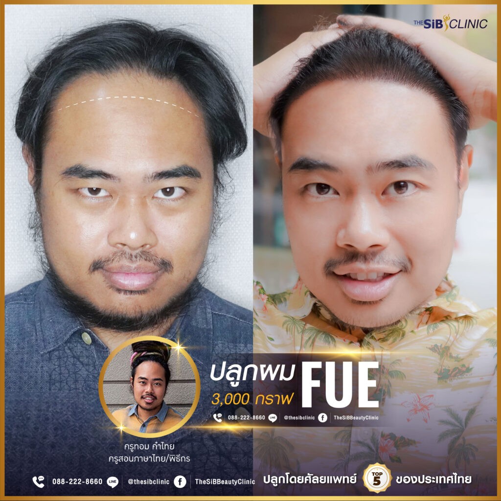 ศัลยกรรมปลูกผม Hair Transplant The SiB Plastic Surgery