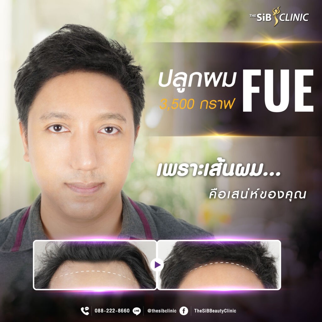 ศัลยกรรมปลูกผม Hair Transplant The SiB Plastic Surgery